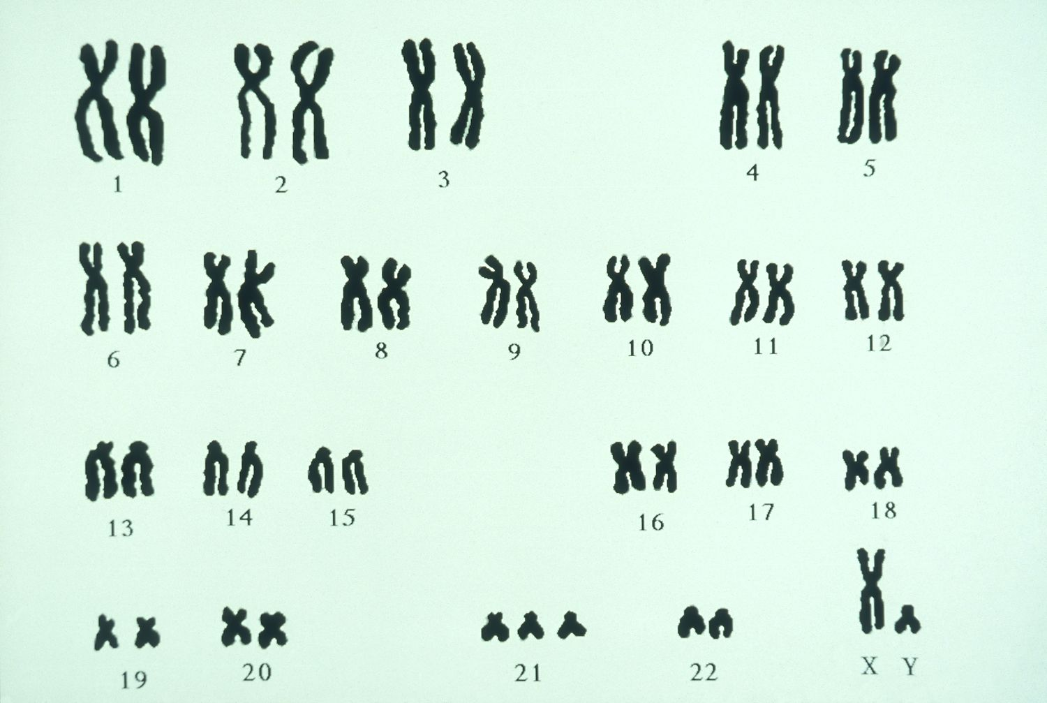 <p><strong>Trisomy </strong>disorder (look at 21)</p>
