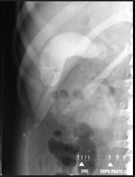 <p>— is used to evaluate gallbladder function and anatomy. Orally administered iopanoic acid concentrates in the gallbladder, opacifying it for visualization.</p>