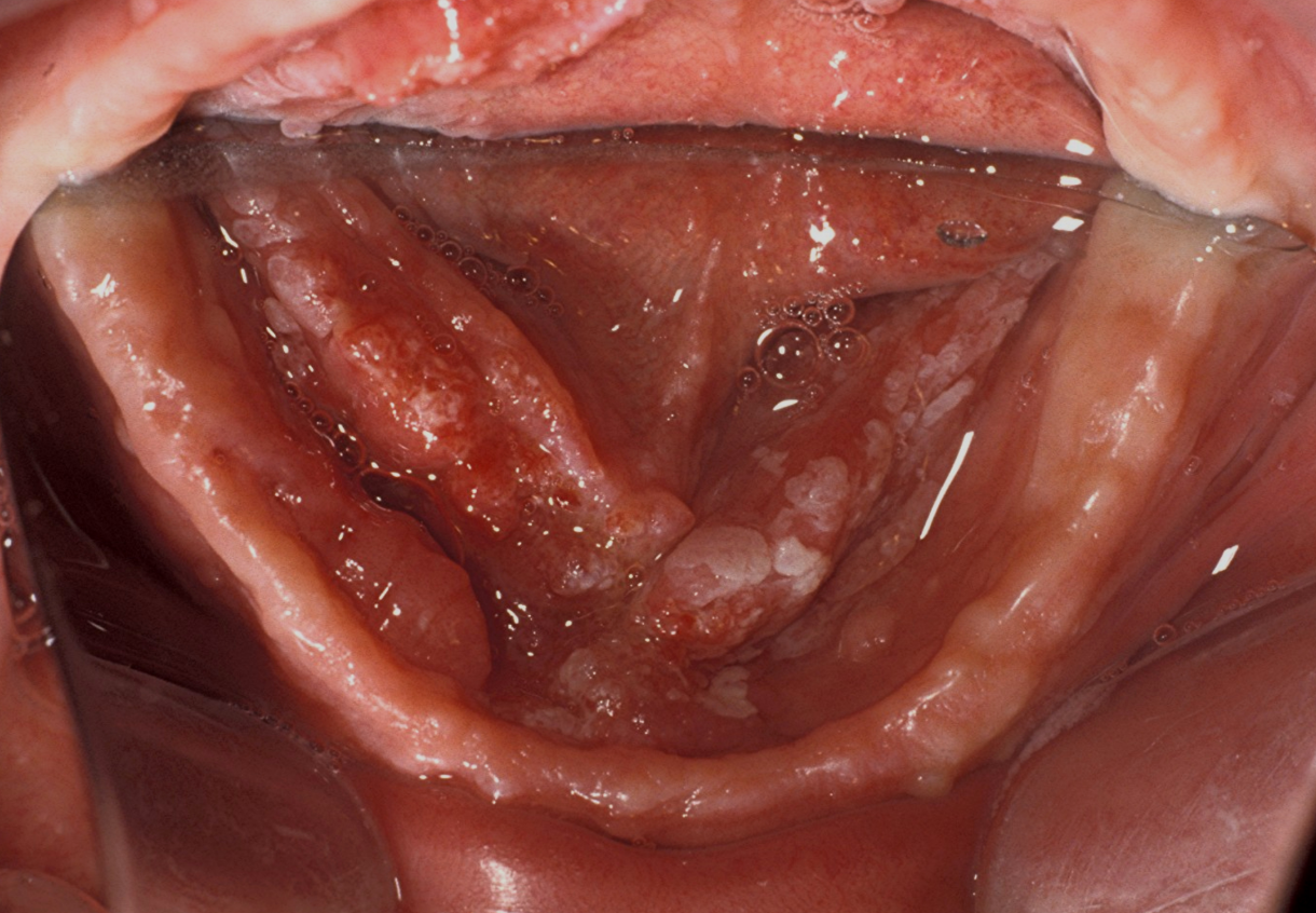 <p>5b. Why is erythroleukplakia concerning?</p>