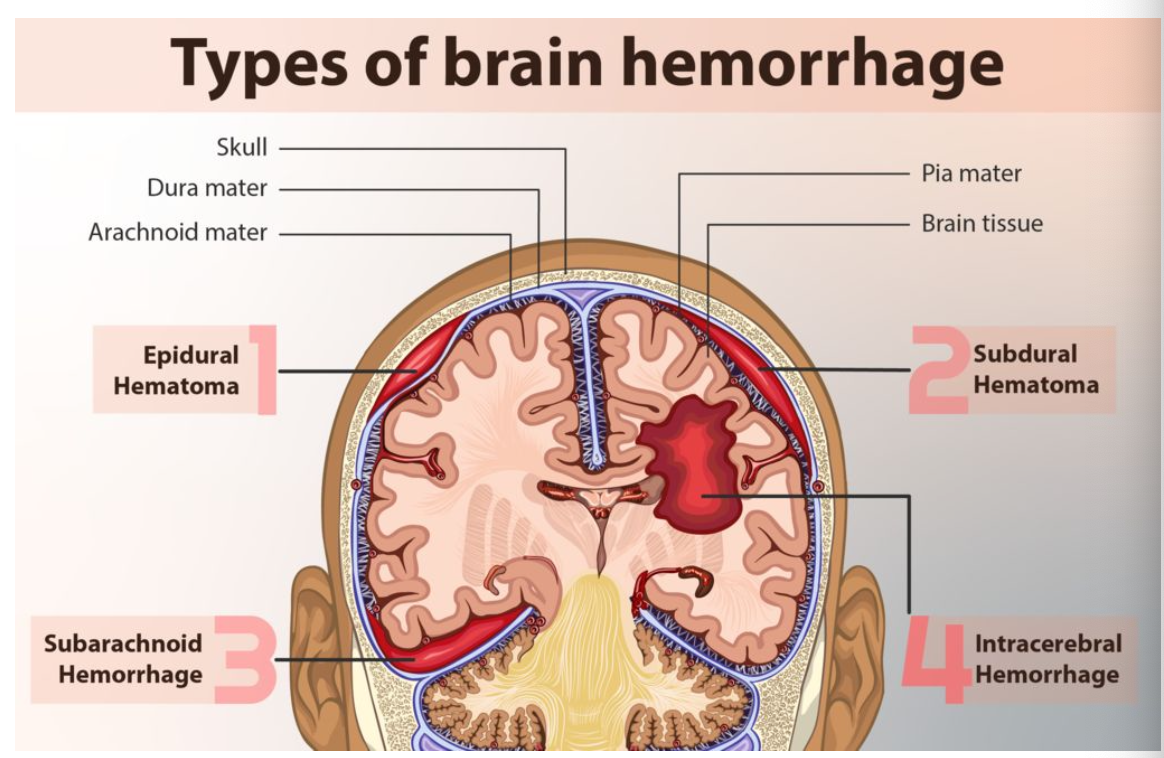 <ul><li><p>epidural hematoma</p></li><li><p>subdural hematoma</p></li><li><p>subarachnoid hemorrhage</p></li><li><p>intracerebral hemorrhage </p></li></ul><p></p>
