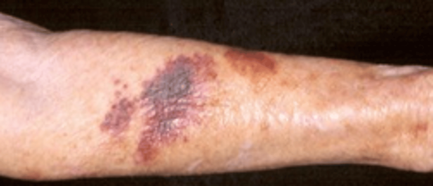 <p>- Physiologic changes (thinning, loss of turgor, dry, flaky, rough)</p><p>- Interosseous atrophy (space between metacarpals)</p><p>- Actinic purpura</p><p>- Pressure ulcers in bed bound patients</p><p>- Hair and scalp</p><p>- Nails</p>
