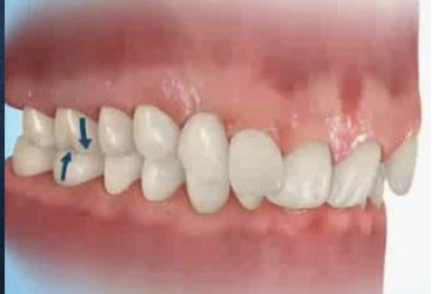 <p>Class II division 2</p>