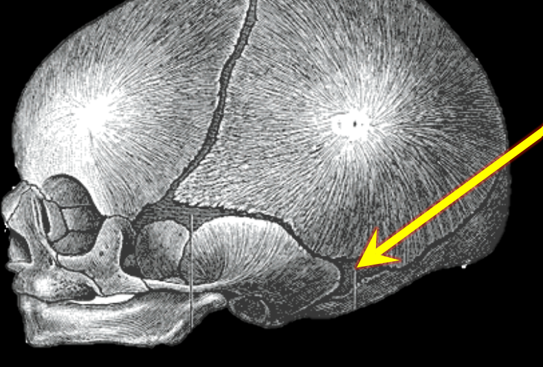 <p>Mastoid fontanel</p>