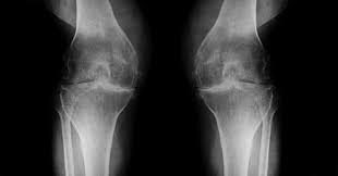 <p>a very common generalized disorder characterized by loss of joint cartilage and ractive new bone formation. Is a part of the wear and tear of the aging process.</p>