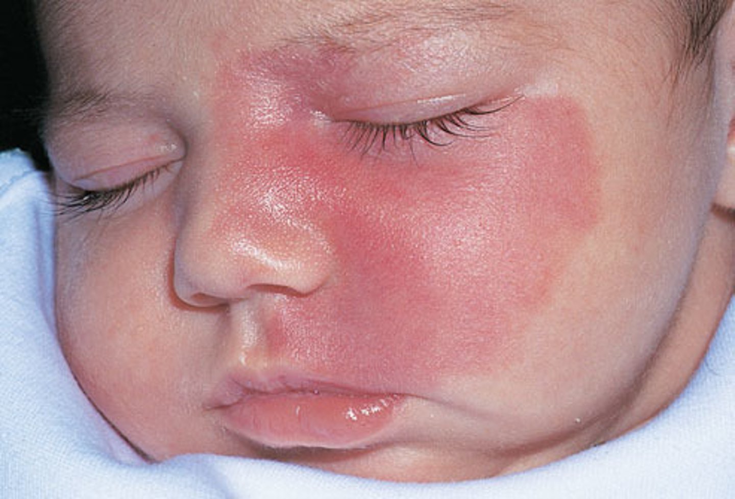 <p>-a congenital benign capillary malformation</p><p><strong>-most common type of vascular malformation</strong></p><p>-occurs in about 3 in 1000 people</p><p>-swollen blood vessels create a reddish-purple discoloration of skin</p><p><strong>-rare cases are a sign of sturge-weber syndrome</strong></p>