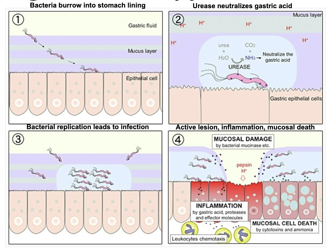 <p>leading cause of peptic ulcers and chronic gastritis in the USA. pathogenesis mechanisms include motility, urease activity, &amp; association with gastric mucosal cells (important virulence factors). long-term infection leads to risk of gastric cancer &amp; MALT lymphoma</p>