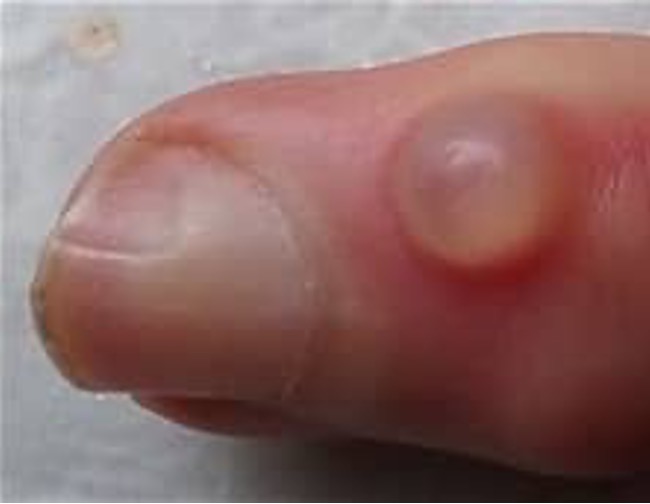 <p>what condition?</p><ul><li><p>translucent papule on dorsum of digit bt DIP and proximal nail fold </p></li><li><p>no capsule (pseudocyst)</p></li><li><p>caused by degeneration of connective tissue and/or joint fluid leaking from osteoarthritic DIP joint</p></li><li><p>mc &gt; 60</p></li></ul><p></p>