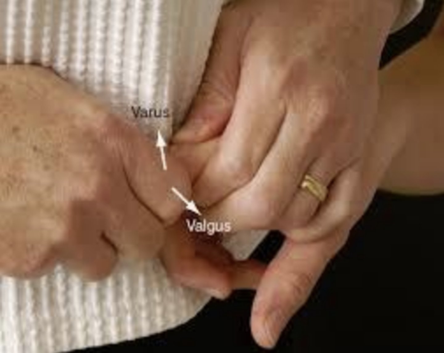 <p>- identify ligament instability, medial or lateral</p><p>- description: fingers are stabilized and supported. varus or valgus stress applied to the joint (proximal or distal interphalangeal) to test the integrity of the collateral ligaments</p><p>result: the results are compared for laxity with those of the uninvolved hand, which is tested first</p>