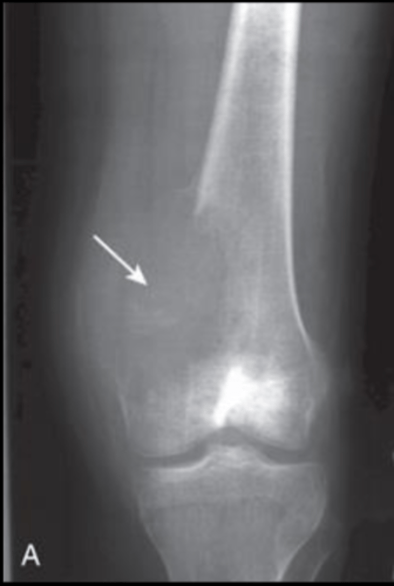 <p>Accurately describe this pattern of bone destruction</p>