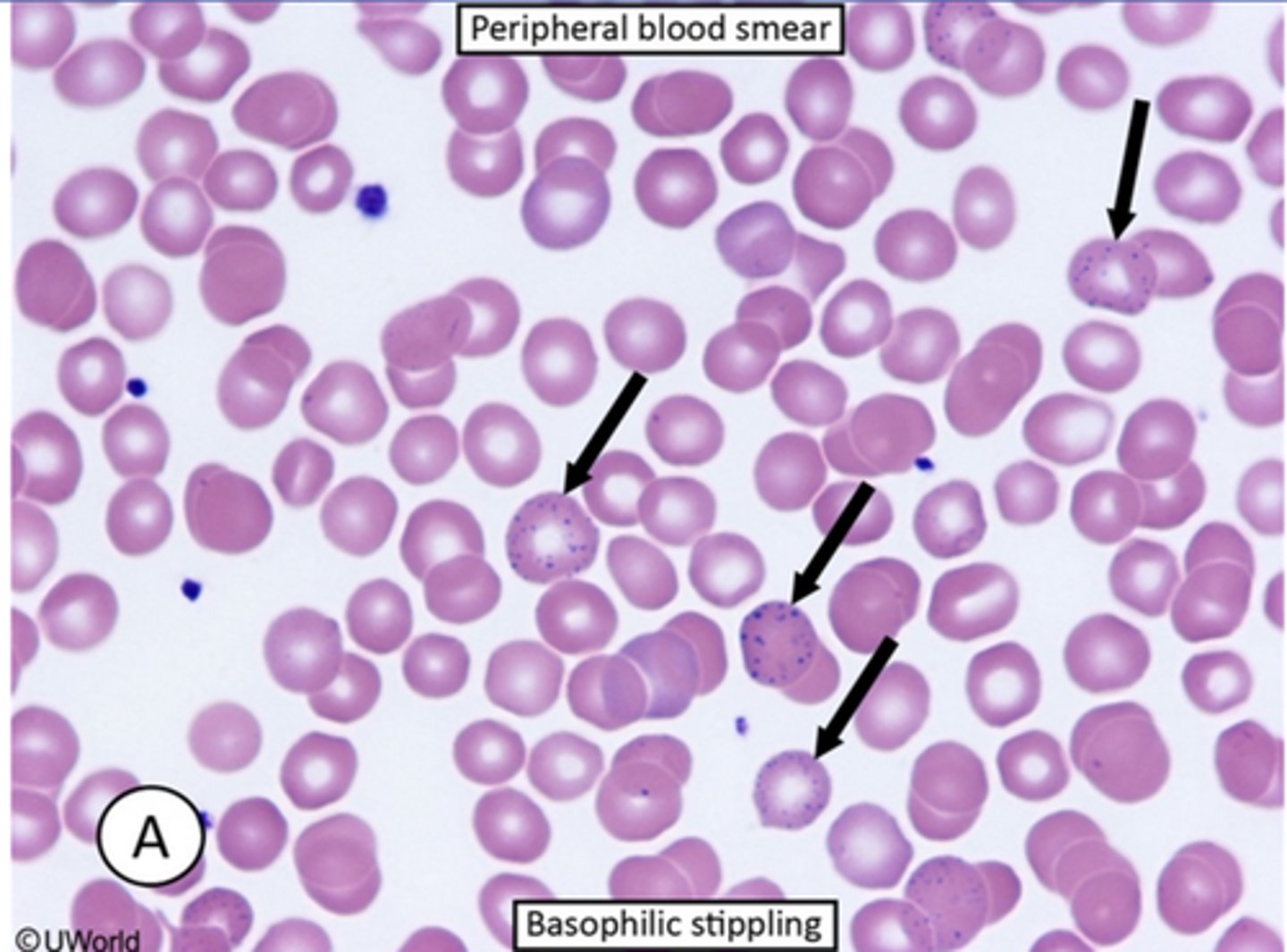 <p>-represents ribosomal precipitates that appear as blue granules of various sizes dispersed throughout the cytoplasm of red blood cells. It is seen with thalaseemias as well as lead or heavy metal poisoning</p>