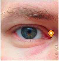 <p>The inner corner of the eye where the eyelids meet</p>