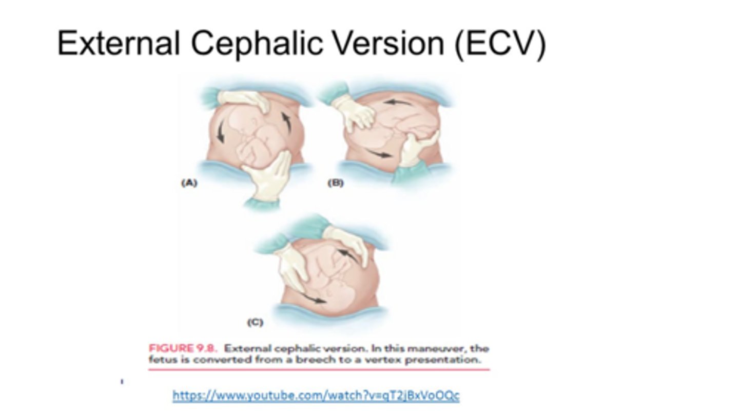 <p>External rotation of the fetus to the head down (cephalic) position</p><p>Attempted after 36 weeks</p><p>Done under ultrasound guidance</p>