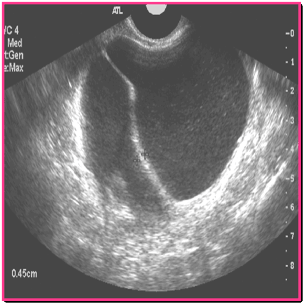 <p>mucinous cystadenoma</p>