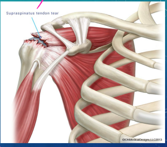 <p><strong>RTC Tears: Background</strong></p><p>-Mechanism of Injury </p><ul><li><p>Acute injury → _____ or forceful pull on the arm </p></li><li><p>Chronic injury → _________ use and irritation or chronic __________</p></li></ul><p>-Types</p><ul><li><p>______ thickness tear → can progress to full thickness tear. The pt will have pain with little to no __________</p></li><li><p>____ thickness tear → increased pain and weakness </p></li></ul><p></p>