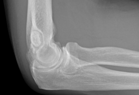 <p>Osteochondritis Dissecans is a Lateral Compression injury in adolescents of articular surface of the capitulum due to</p>