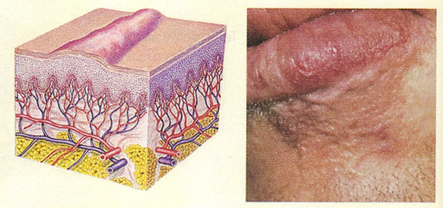<p>Secondary lesions</p>