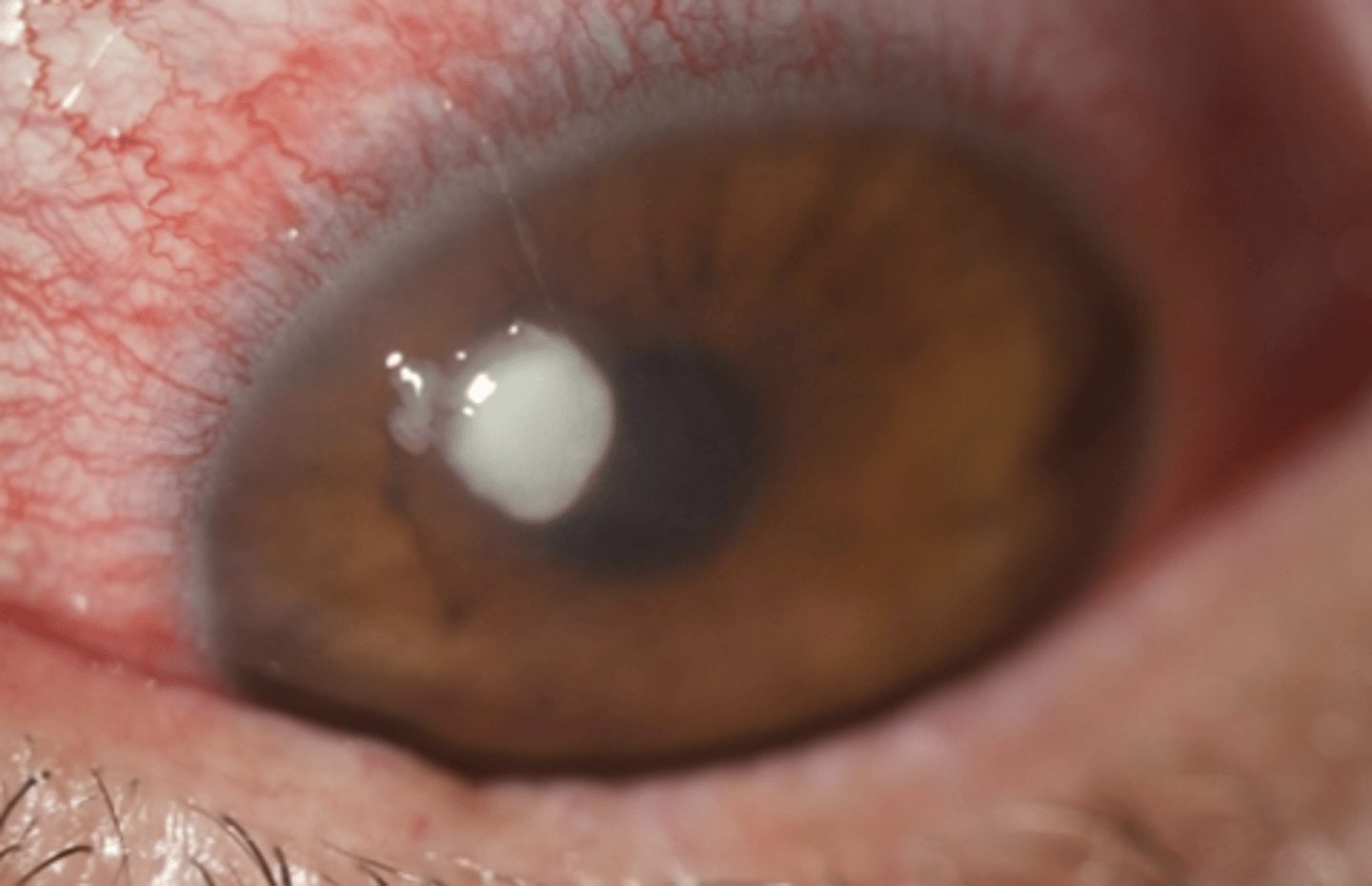 <p><u>Etio</u>: viral, bacterial, fungal, or parasites</p><p><u>S&amp;S</u>: inflammation/ulceration of the cornea, FB sensation, <strong>red eye w/ PAIN</strong>, photophobia, <strong>corneal opacity</strong></p><p><u>Tx</u>: emergent consult to ophthalmologist</p>