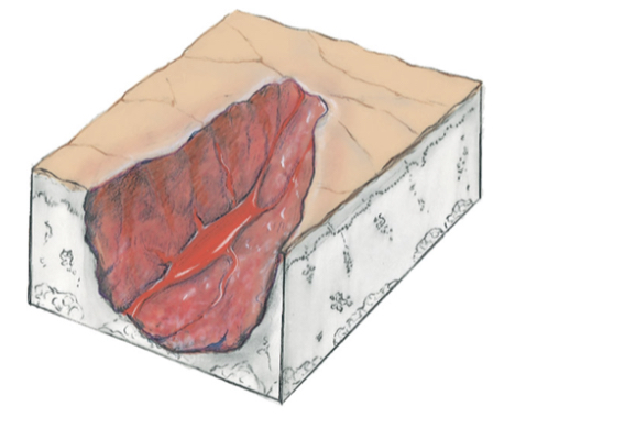 Ulcer
