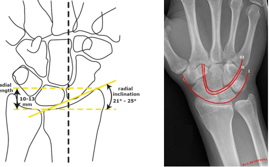 <p>What views do you need for a wrist x-ray?</p><p>-__ → radial inclination of 20-25 degrees, should intersect with the ulna. Carpal arcs </p><p>-______ → distal radius, lunate, and capitate. Should be in a straight line </p><p>-_______</p>