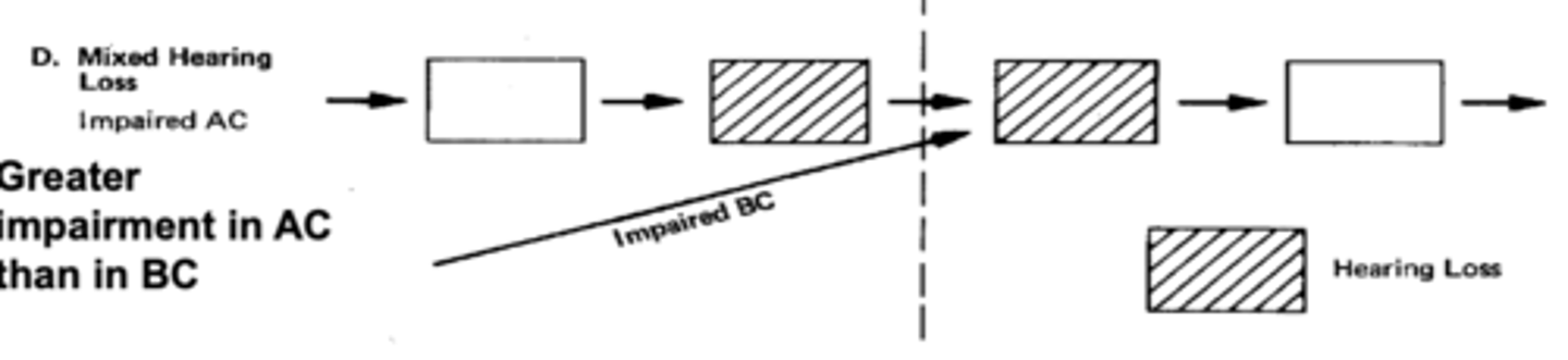 <p>- both middle and inner ear affected (AC/BC IMPAIRED).</p><p>- two impedance blocks.</p><p>- more impairment in AC than BC.</p><p>- cause of possible lesion could be later stage of otosclerosis.</p>