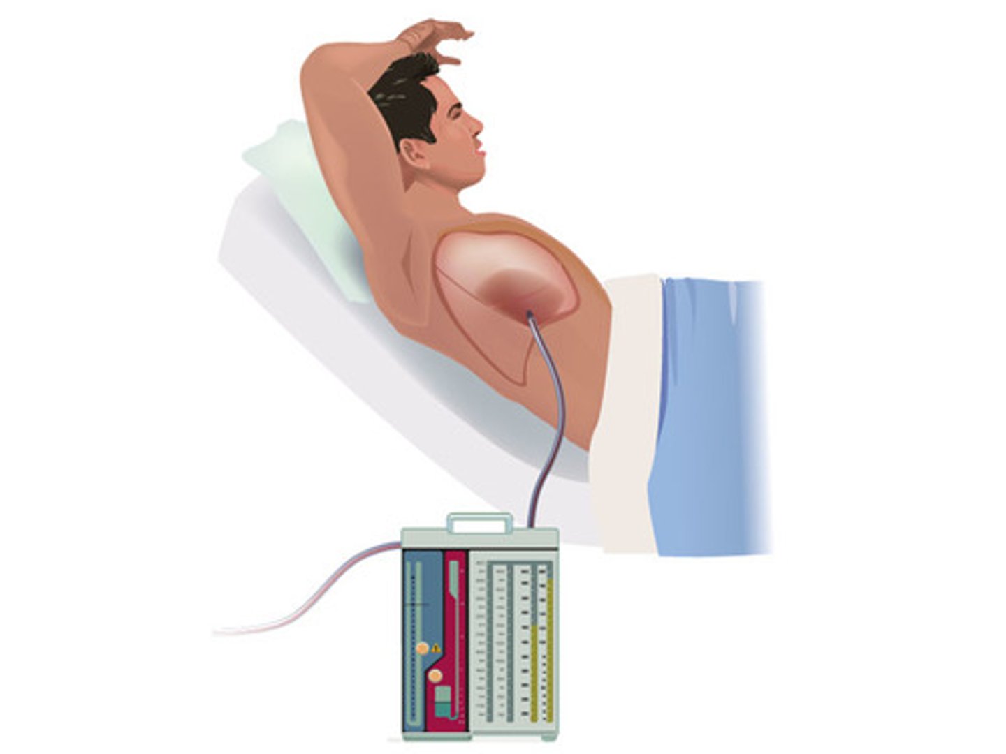 <p>- Chest trap must be maintained upright and below chest.</p><p>- Look for bubbles in the trap.</p><p>- Make sure tube is secure before ambulation and ask nursing to disconnect wall suction.</p>