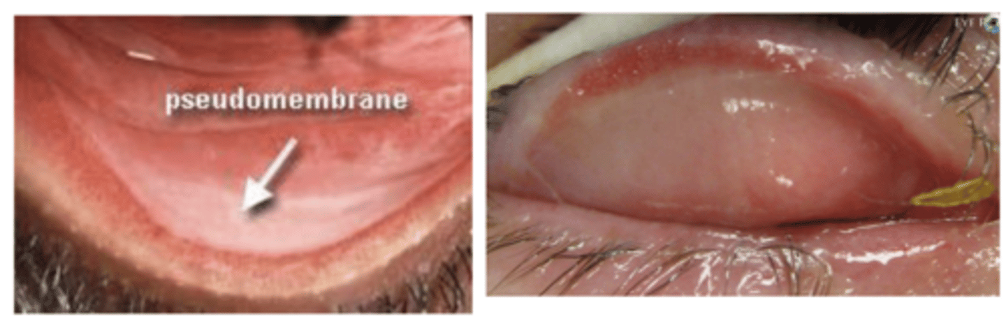 <p>What is a pseudomembranve vs a membrane?</p>