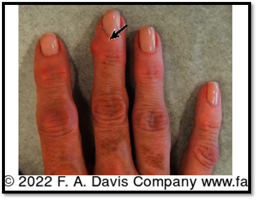<p>Bony enlargements on the distal interphalangeal joints (DIP); commonly seen in osteoarthritis</p>