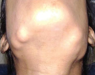 <p>Gardner syndrome</p>