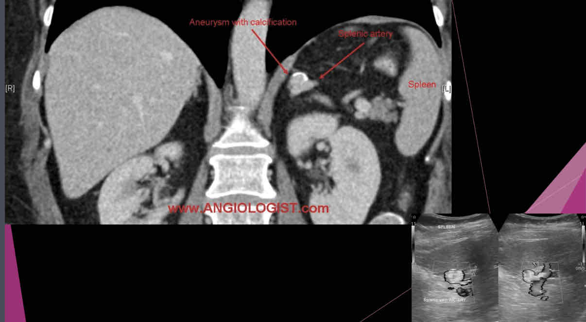 <p>What describes the following?</p><p>•Those may be single or multiple and are most commonly involving the distal portion of the artery.</p><p style="text-align: start">•Peripheral calcification is common, and mural thrombus may be present</p><p style="text-align: start">•Usually, calcified circle seen in LUQ on X-ray and this is suspected</p><p style="text-align: start">•Sonographically: may appear as cystic mass, or if calcified a hyperechoic shadow foci in area of artery</p>