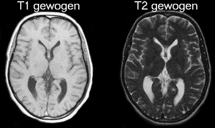 <ul><li><p>obv sterke magneet</p><ul><li><p>meer waterofatomen = meer signaal</p></li></ul></li><li><p>indicaties</p><ul><li><p>kleine contrast afwijking weke delen</p></li><li><p>detectie + karakterisatie tumoren/metastasen/infecties</p></li><li><p>inspectie vaten</p></li></ul></li><li><p>Soorten</p><ul><li><p><span style="color: blue">T1 gewogen MRI</span> = vocht zwart</p></li><li><p><span style="color: blue">T2 gewogen MRI</span> = vocht wit (<span style="color: #f69a07">op T2 Wordt Water Wit</span>)</p></li></ul></li><li><p>voordelen = géén ioniserende straling, goede kwaliteit, pijnloos, 3D</p></li><li><p>nadelen = duur, claustrofobie/lawaai, bewegingsgevoelig, obesitas werkt niet</p><ul><li><p>magnetisch → contraindicatie = pacemaker, insulinepomp, metaal</p></li></ul></li><li><p>contrastvloeistof = <span style="color: #06fafc"><strong>gadolinium </strong></span>(= goed afbeelden hersentumoren)</p></li></ul><p></p>