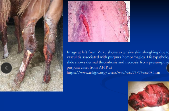 <ul><li><p><span style="color: rgb(136, 136, 136);"><strong>Et:</strong></span><span><strong> </strong><u>IM, </u>post-<u>Strep equi equi</u> infection or vax</span></p><ul><li><p><span>leukocytoclastic <u>vasculitis</u>, fibrinoid necrosis</span></p></li></ul></li><li><p><span style="color: rgb(136, 136, 136);"><strong>Cs:</strong></span><span> <u>limb/ventral/facial edema, petechiation, </u>urticaria, fever, necrosis/sloughing, myocarditis, laminitis, infarctive myopathy</span></p><ul><li><p><span><u>multisystem</u> involvement</span></p></li></ul></li><li><p><span style="color: rgb(136, 136, 136);"><strong>Dt: </strong></span><span>history of strangles/vax, <u>high SeM titers for Strep, high globulins&nbsp;</u></span></p></li><li><p><span style="color: rgb(136, 136, 136);"><strong>Tx:</strong></span><span> drain abscesses, antibiotics, <strong><u>immune suppression,</u></strong> hydrotherapy, <strong><u>eliminate Ag,</u></strong><u> compression</u></span></p><ul><li><p><span>Prognosis is fair-good; relapses possible</span></p></li></ul></li></ul><p></p>