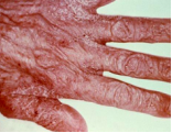 <p>COMMON DISORDERS SEEN WITH AGING</p><p></p><ul><li><p>INFECTION (parasitic, mites)</p></li><li><p>Elderly individuals may be at a higher risk of developing scabies than others</p></li><li><p><span style="color: red;">intense itching (especially at night)</span><span> </span></p></li><li><p><span>and a red rash or tiny burrows on the skin</span></p></li></ul><p></p>