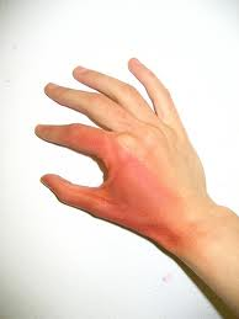 <p>1st degree burn-Symptoms</p>