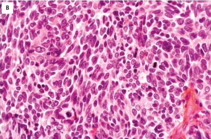 <p>Carcinoma de células pequeñas, características celulares</p>