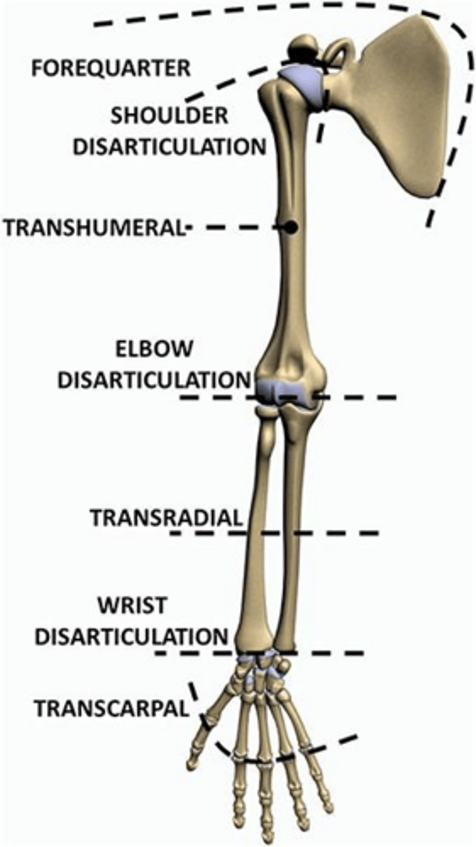 <p>The piece of the prosthesis that fits around the residual limb to attach the prosthesis.</p>