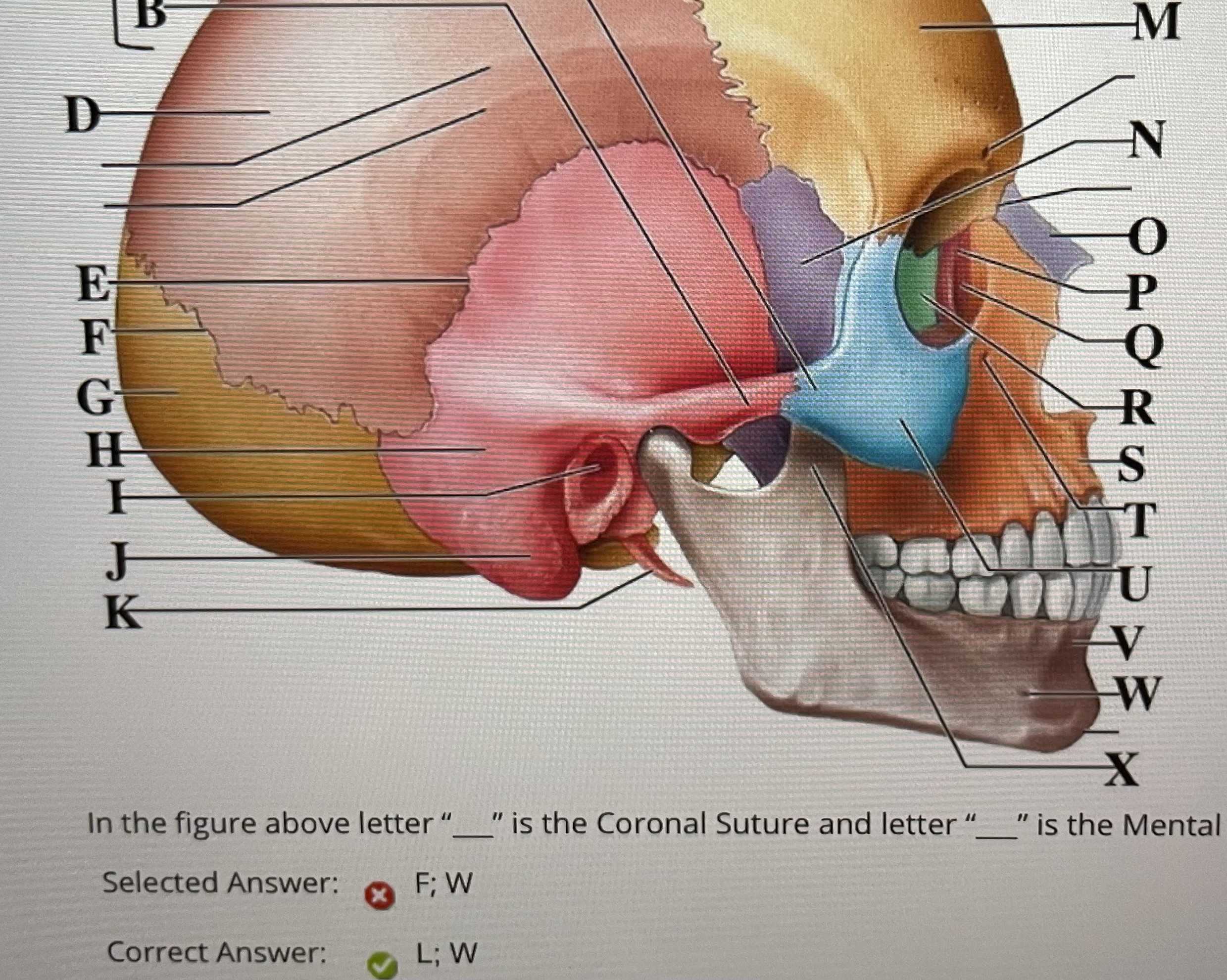 In the figure above  *is the coronal suture and* _ is the mental foramen 