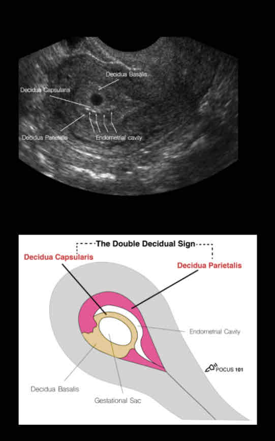 <p><span>• Anechoic (dark)</span><br><span>• Round structure with an echogenic</span><br><span>(bright) border.</span><br><span>• Typically, it is in the upper 1/3 of the</span><br><span>uterine fundus.</span><br><span>• Make sure the sac is in the uterus by</span><br><span>tracking the vaginal stripe to the uterus.</span></p>