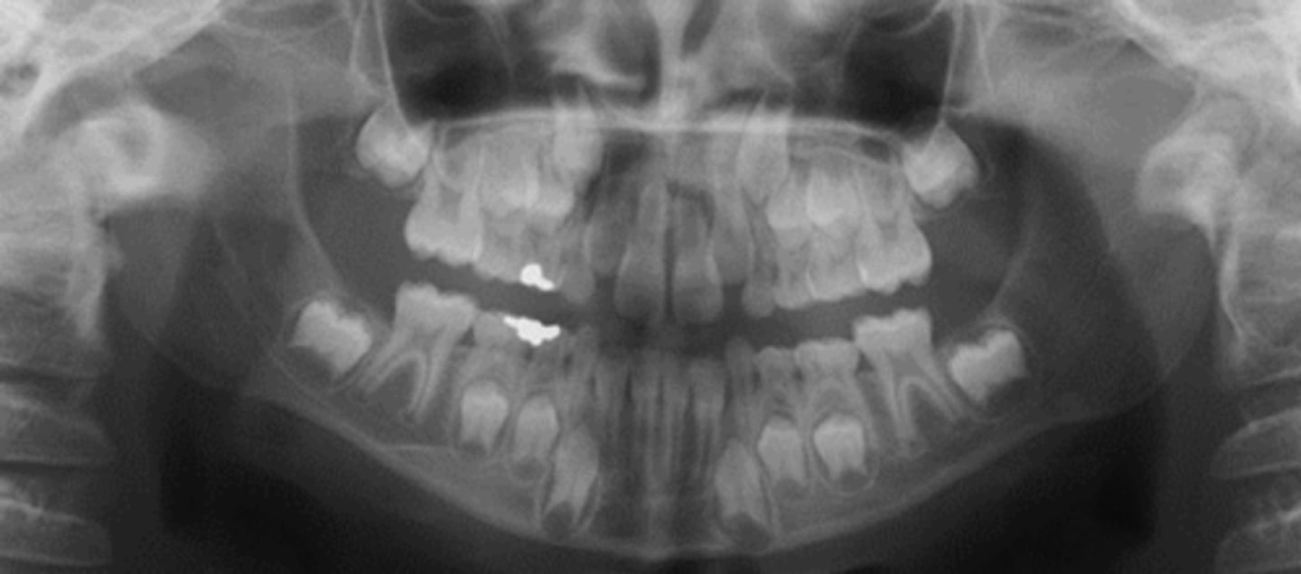 <p>what is the approximate age of this patient?</p><p>a. 5-6</p><p>b. 7-8</p><p>c. 9-10</p><p>d. 11-12</p>