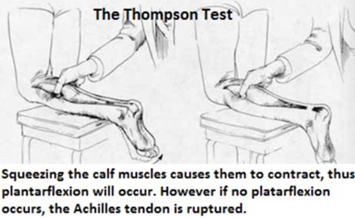 <p>The Thompson Squeeze Test</p>