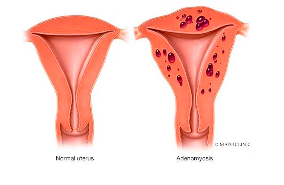 <p>adenomyosis</p>