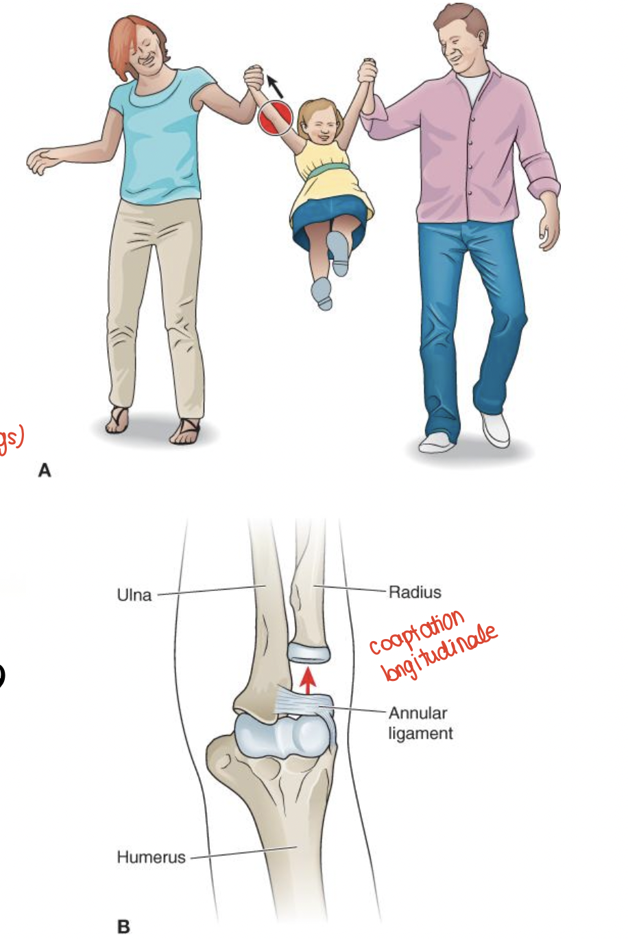 <p><span data-name="black_small_square" data-type="emoji">▪</span> Une luxation ou sortie de la tête radiale peut arriver chez les jeunes enfants lors d’une traction importante de l’avant-bras (parce que les muscles, tête radiale et ligaments ne sont pas encore complètement développés)</p>