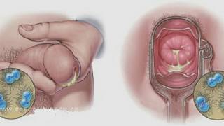 <p>Caused by Neisseria Gonorrhea </p><p>symptoms : in men- painful pee &amp; pus  </p><p>women- little to no symptoms </p><ul><li><p>Fimbriae - attachment</p></li><li><p>opa proteins -prevent T-cell activation </p></li><li><p>IgA protase -breaks down IgA </p></li><li><p>antigenic variability - changes its surface </p></li></ul><p>attaches to the epotheail lining </p><p>can progress to PID </p><p></p>