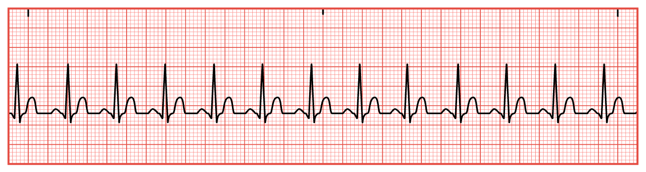 <ol type="1"><li><p><span style="font-family: &quot;Times New Roman&quot;;">Calculate heart rate.</span></p></li><li><p><span style="font-family: &quot;Times New Roman&quot;;">Determine if heart rhythm is regular.</span></p></li><li><p><span style="font-family: &quot;Times New Roman&quot;;">Assess for P waves.</span></p></li><li><p><span style="font-family: &quot;Times New Roman&quot;;">Measure PR interval.</span></p></li><li><p><span style="font-family: &quot;Times New Roman&quot;;">Measure duration of QRS complex.</span></p></li></ol><p></p>