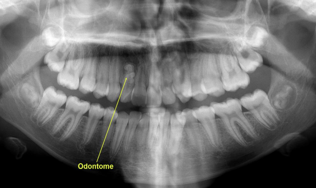 <ul><li><p>odontome: a benign tooth structure consisting of normal dental tissues that is not actually a tooth</p></li></ul><p></p>