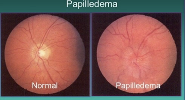 <p>What does this refer to</p><ul><li><p>Occurs when the Optic nerve is swollen due to pressure in or around the brain</p></li><li><p>Symptoms </p><ul><li><p>Visual disturbances</p></li><li><p>Headaches &amp; nausea</p></li></ul></li></ul><p></p>