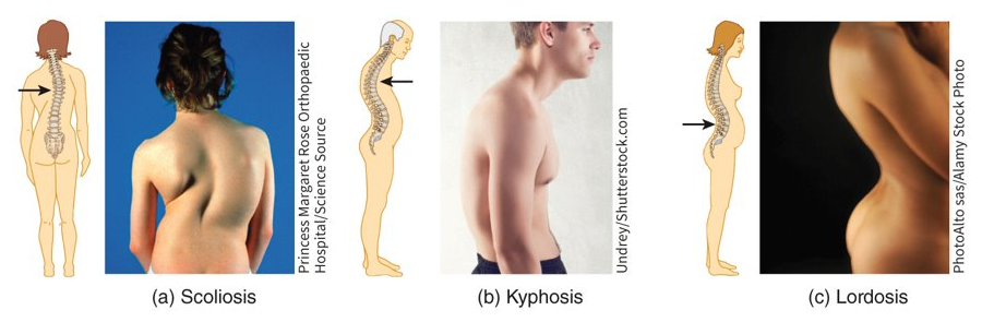 <p>scoliosis (lateral curvature), kyphosis (thoracic curve), and lordosis (lumbar curve)</p>