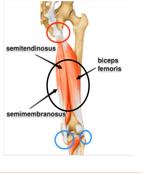 <ul><li><p>Origin: Ischial tuberosity (red); Insettion on tibia/fibula (blue circles)</p></li><li><p>Smaller than quads, can't handle as much load</p></li><li><p>Prevalence: </p><ul><li><p>2/3rd biceps femoris (shortest group, most angulated</p></li><li><p>1/3rd semitendinosus</p></li></ul></li><li><p>Intramuscular tendon/CT issues</p></li><li><p>Very high recurrence rate: acute on chronic</p></li><li><p>MOI: sprinting, hip flexed while knee extended, eccentric loading</p></li><li><p>S/S: thigh swollen and discolored (ecchymosis), fiber disruption, hematoma w edema</p></li><li><p>Middle of the hamstring usually acute; Distal and proximal often overuse tendon injury from from running or cycling</p></li><li><p>Management: PRICE, restore strength and flexibility, neoprene sleve or ACE bandage</p></li></ul><p></p>