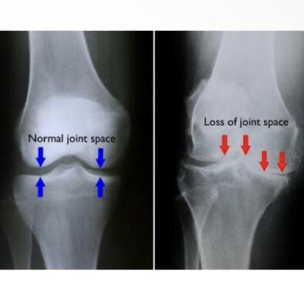 <p>What is osteoarthritis </p>
