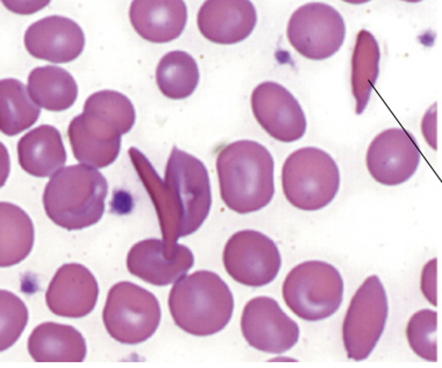 <p>What disease is caused by the abnormal cells?</p>