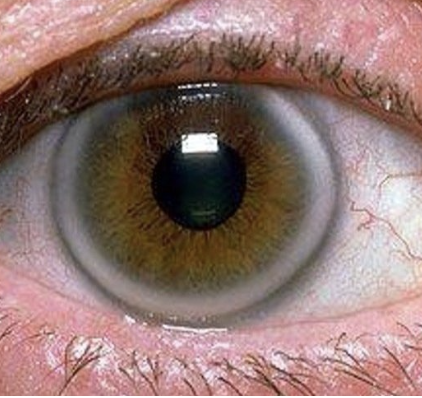 <p>One of the Normal Findings for <strong><em>10. Inspect the cornea and lens</em></strong></p><ul><li><p>Normal condition in older clients</p></li><li><p>White arc around the limbus</p></li><li><p>Has no effect on vision</p></li></ul><p></p>